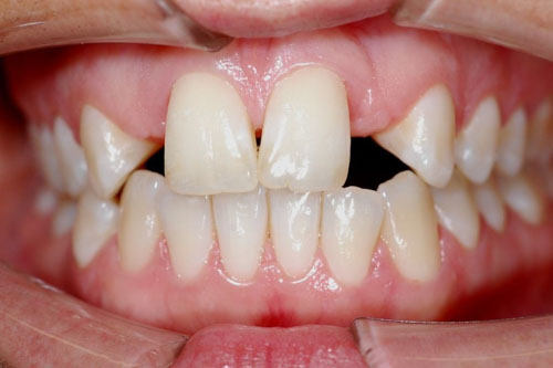 Răng cửa thưa do thiếu mầm răng vĩnh viễn