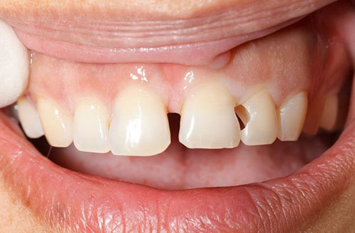 Răng cửa thưa làm tăng nguy cơ bị sâu răng