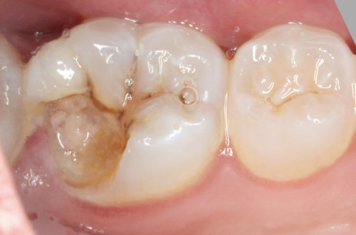 Răng hàm bị vỡ tạo điều kiện cho vi khuẩn xâm nhập gây viêm nhiễm