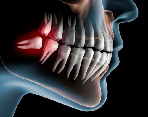 Răng khôn là chiếc răng mọc cuối cùng trên cung hàm