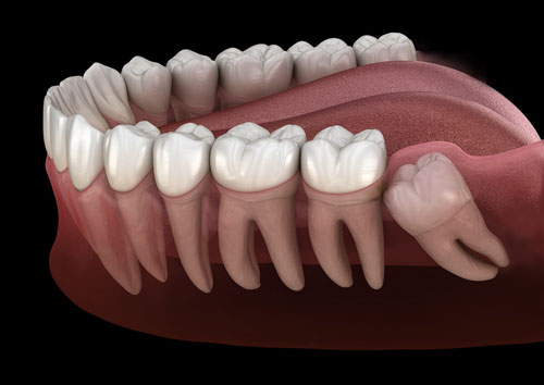Răng khôn mọc lệch do cung hàm không còn khoảng trống