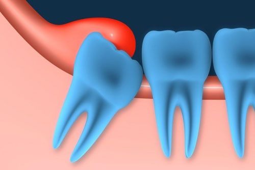 Răng khôn mọc lệch gây ra những cơn đau nhức khó chịu