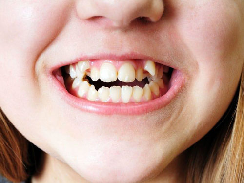 Răng lòi xỉ là tình trạng răng mọc lệch, mọc lộn xộn