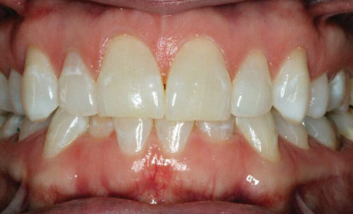 Răng nhiễm fluor khiến men răng không đều màu