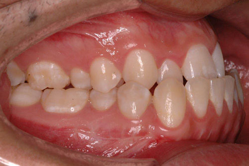 Răng quặp do xương hàm dưới phát triển