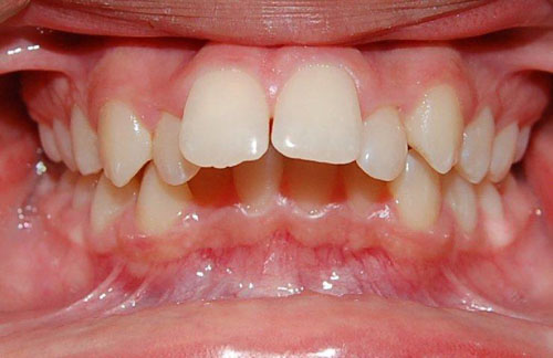 Răng quặp do xương hàm trên phát triển quá mức