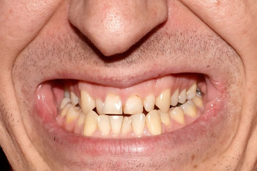 Răng quặp kèm theo tình trạng các răng mọc lộn xộn, không đều