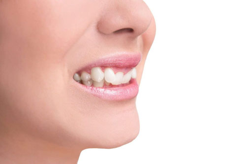 Răng quặp là một dạng sai lệch khớp cắn
