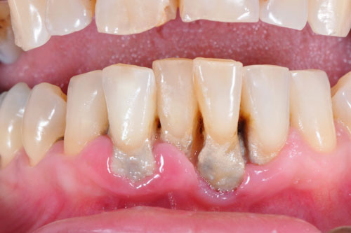 Răng quặp làm tăng nguy cơ mắc bệnh nha chu