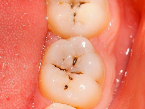 Răng sâu mức độ 1 với những đốm đen trên bề mặt răng