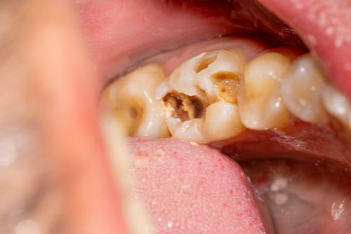 Răng sâu, viêm tủy dễ bị đau nhức, ê buốt khi ăn uống