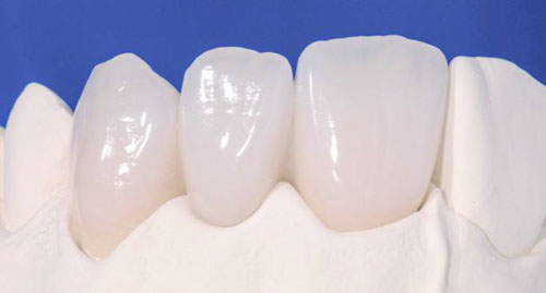 Răng sứ Emax được sản xuất bởi tập đoàn Siroma