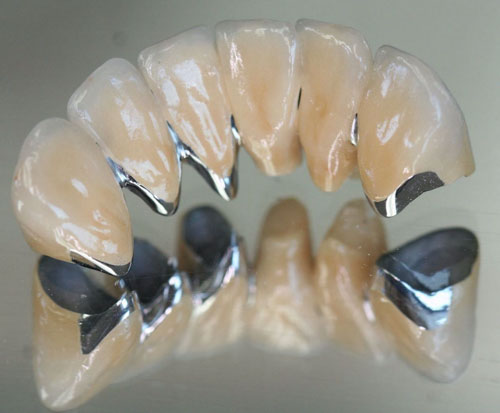 Răng sứ Titan Vita
