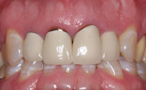 Răng sứ Titan xảy ra tình trạng đen viền nướu sau một thời gian sử dụng