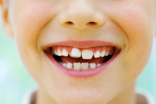 Răng sữa mọc lệch là tình trạng răng miệng phổ biến ở trẻ