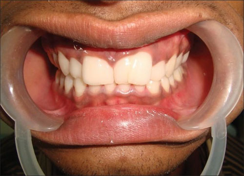 Răng thừa giữa 2 răng cửa khiến thẩm mỹ nụ cười bị suy giảm