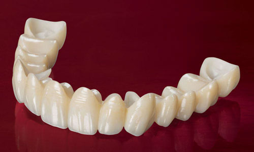 Răng toàn sứ được đúc từ sứ nguyên khối không lẫn tạp chất