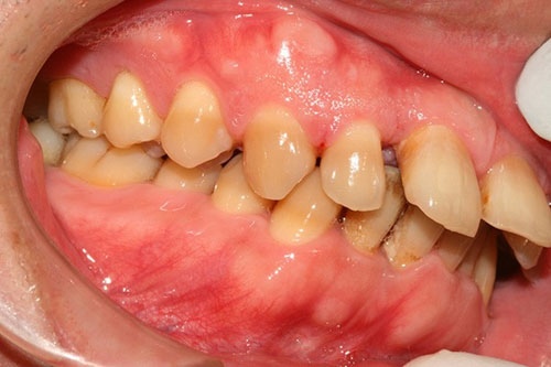 Răng vẩu là một trong những nguyên nhân làm răng cửa hở