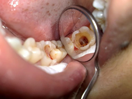 Sâu răng cấp độ 3 làm tổn thương đến tủy răng