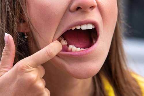Sâu răng để lâu không điều trị gây mất răng sớm