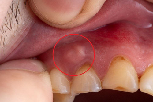 Sâu răng gây áp xe răng