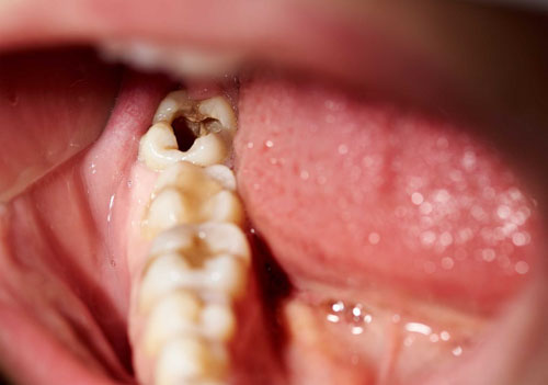 Sâu răng là một trong những bệnh lý về men răng thường gặp