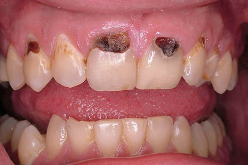 Sâu răng là một trong những tác nhân khiến chân răng bị đen