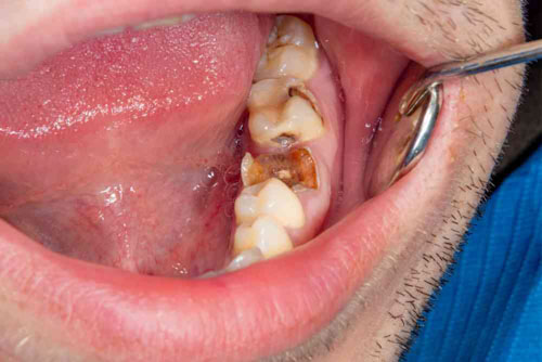 Sâu răng lan sang các răng kế cận