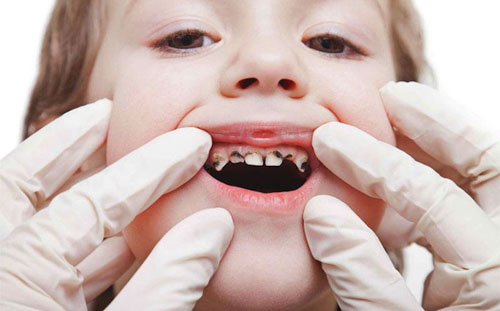 Sún răng thường xảy ra ở lứa tuổi từ 1 - 3 tuổi