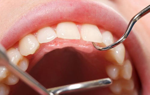 Tại sao cần phải điều trị sưng mộng răng?