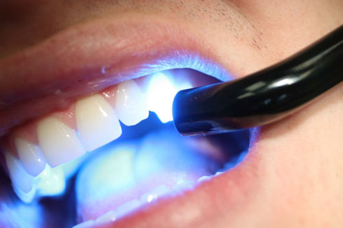 Tạo răng khểnh bằng cách đắp Composite