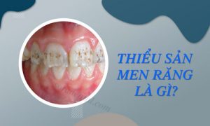 Read more about the article Thiểu sản men răng là gì? Và biện pháp điều trị