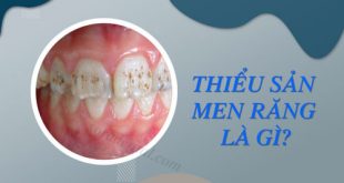 Thiểu sản men răng là gì?