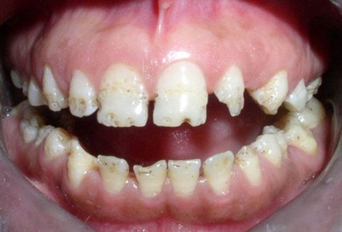 Thiểu sản men răng là nguyên nhân gây mòn cổ chân răng