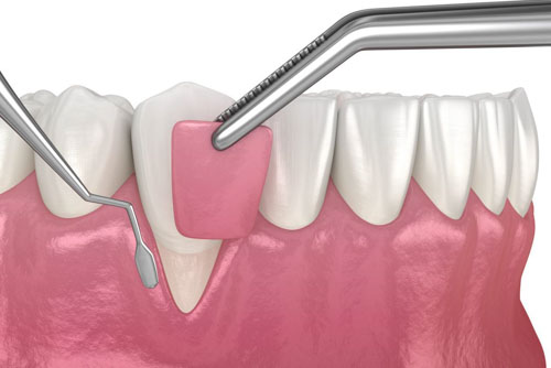 Tiến hành ghép nướu để cố định răng, ngăn chặn tình trạng mất răng