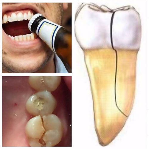 Dùng răng mở nắp chai có nguy cơ cao gây nứt mẻ răng