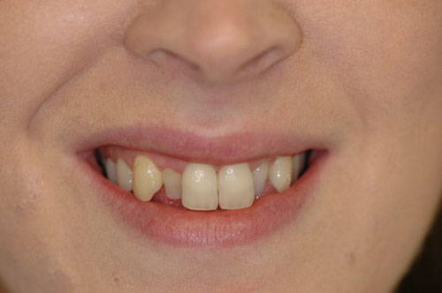Tình trạng hai răng cửa bên hàm trên quặp vào trong khi các răng còn lại đều thẳng đều
