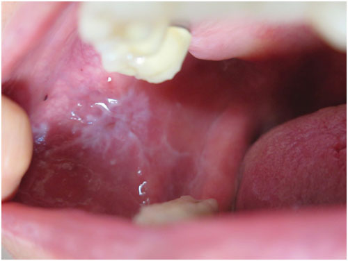 Tình trạng lưỡi trắng ở người bị liken phẳng trong miệng