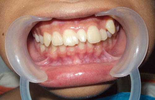 Tình trạng răng nhỏ mọc giữa hai răng cửa