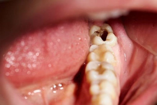 Tình trạng răng sâu
