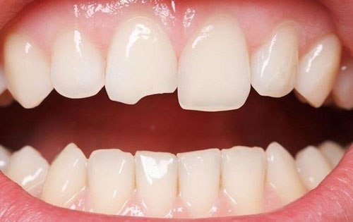Tình trạng răng sứt mẻ