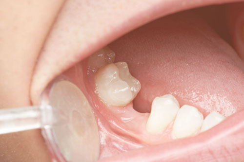 Tình trạng tiêu xương hàm do mất răng