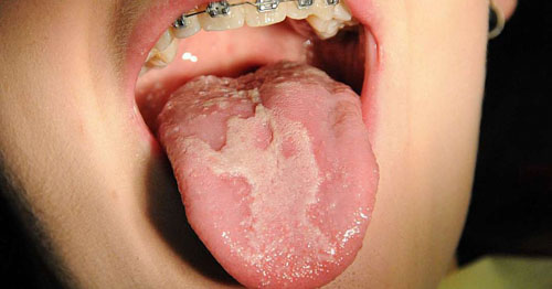 Tổn thương do niềng răng cũng là nguyên nhân gây viêm lưỡi