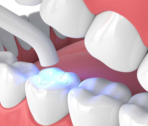 Trám răng cho những trường hợp răng hàm bị mẻ nhỏ