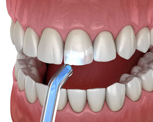 Trám răng giúp khắc phục tình trạng răng nứt ngang