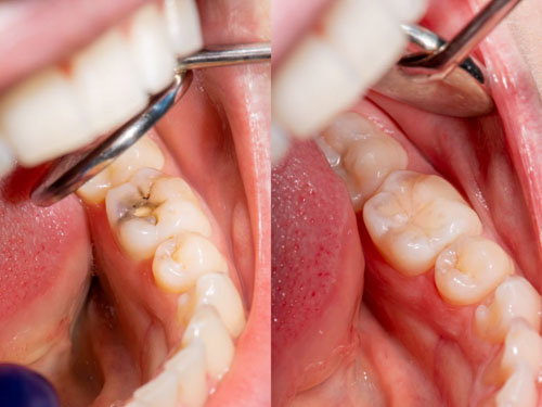 Trám răng khắc phục răng hàm bị mẻ
