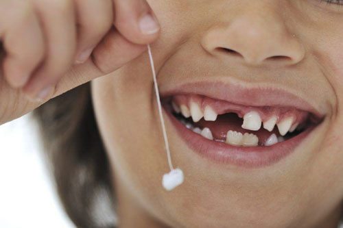 Trẻ thay răng sữa trễ cũng là nguyên nhân khiến răng bị mọc lòi xỉ