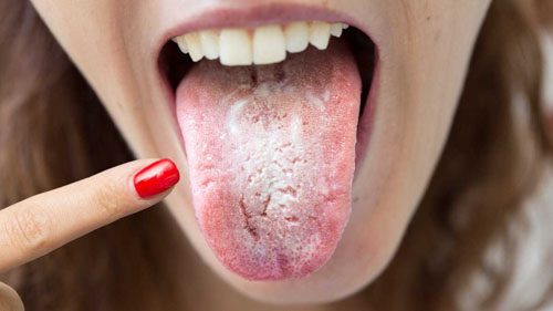 Triệu chứng của bệnh viêm lưỡi
