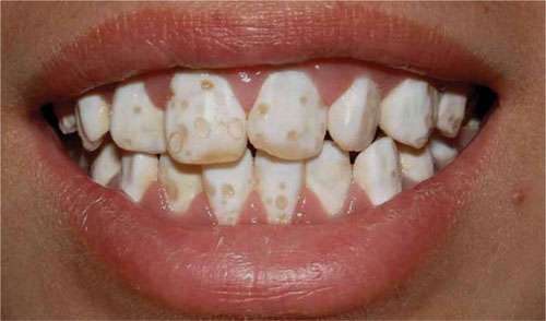 Triệu chứng của thiểu sản men răng
