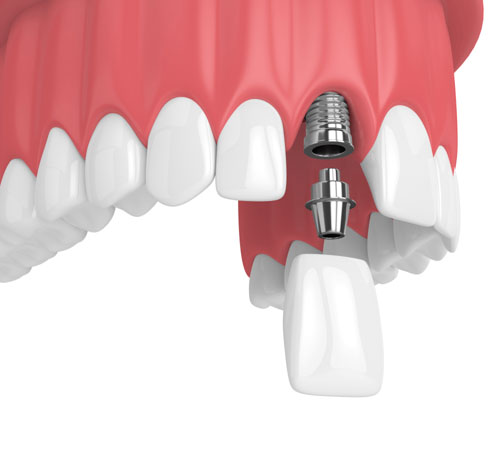 Trồng răng Implant là giải pháp phục hình răng đã mất toàn diện nhất
